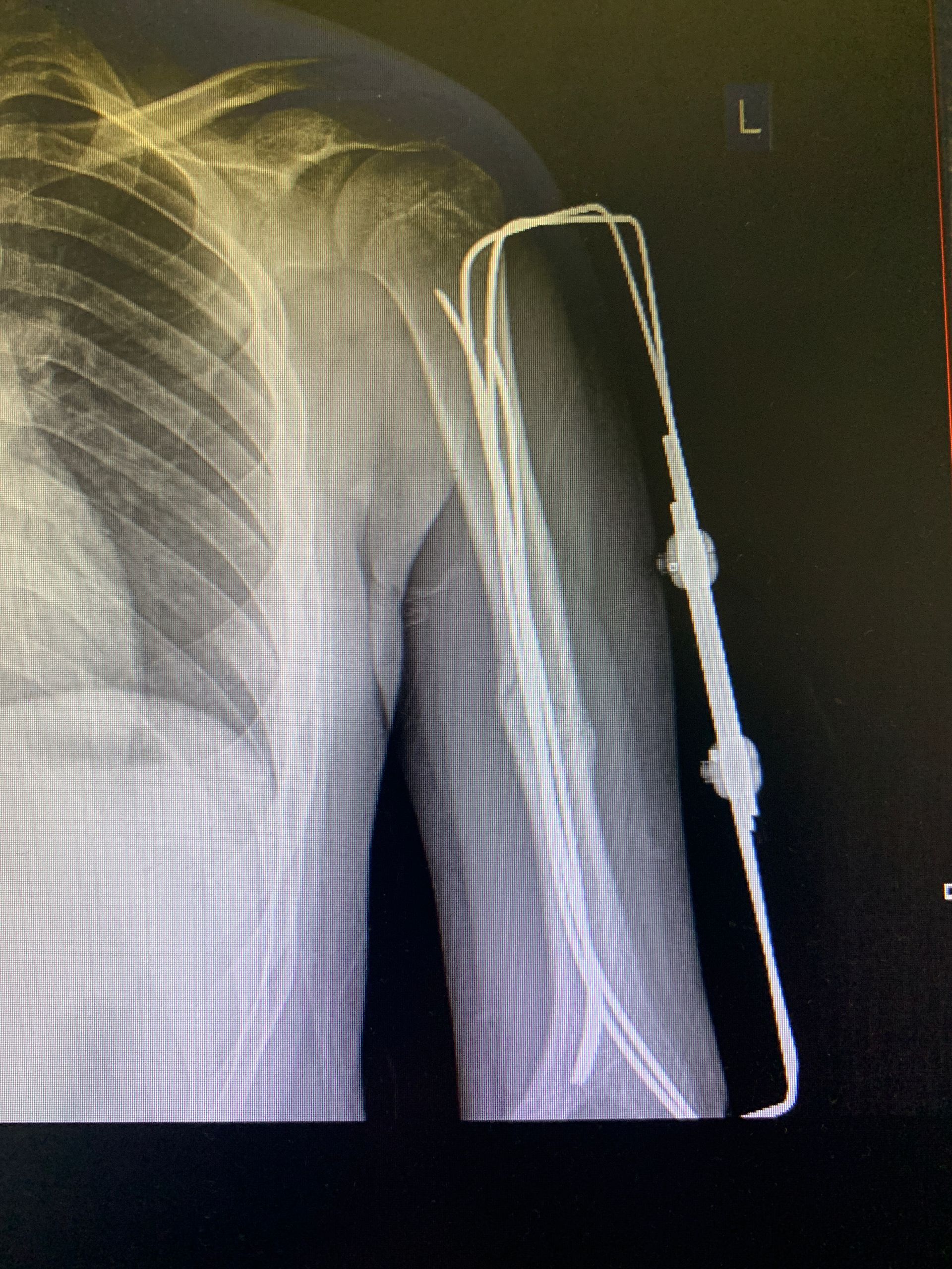 Radiografia del braccio sinistro di una persona che mostra un dispositivo medico o un catetere con fili che fuoriescono dal corpo.