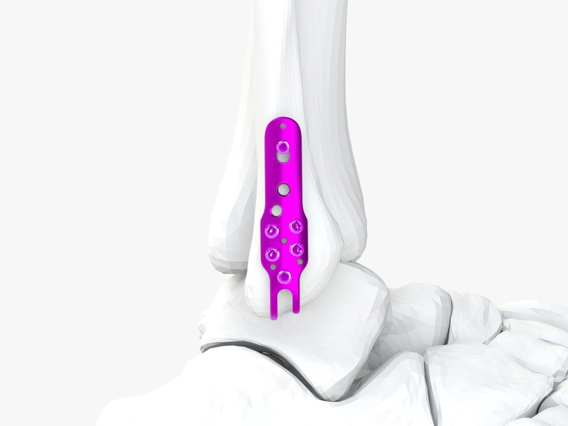 Una placca ossea metallica per uso medico, dotata di fori multipli per viti e di un design curvo, per la fissazione chirurgica ortopedica.