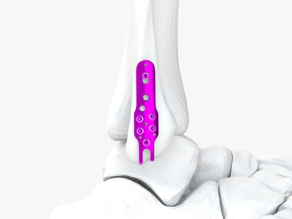 Una placca ossea metallica per uso medico, dotata di fori multipli per viti e di un design curvo, per la fissazione chirurgica ortopedica.