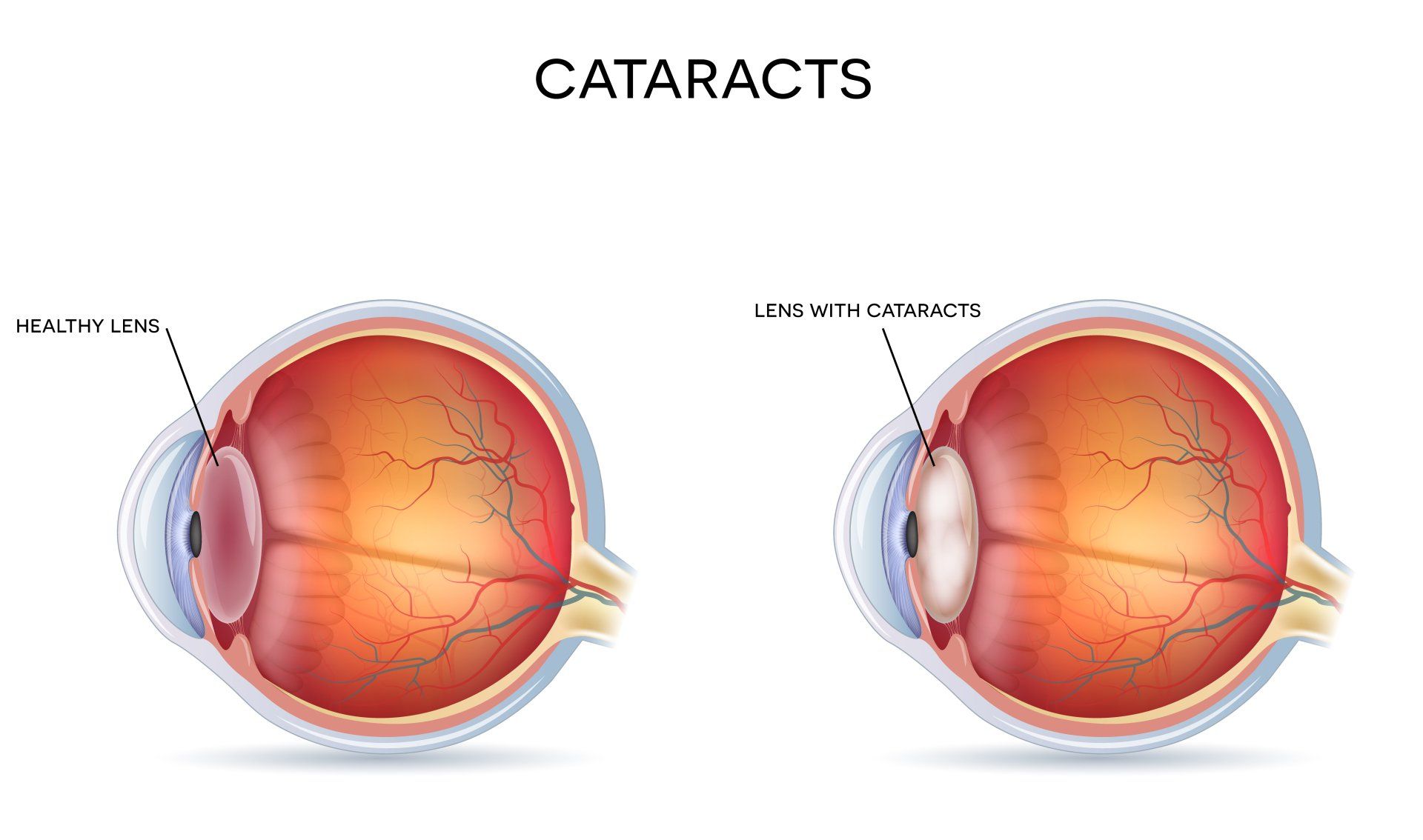 cataract diagram showing healthy lens and lens with cataract