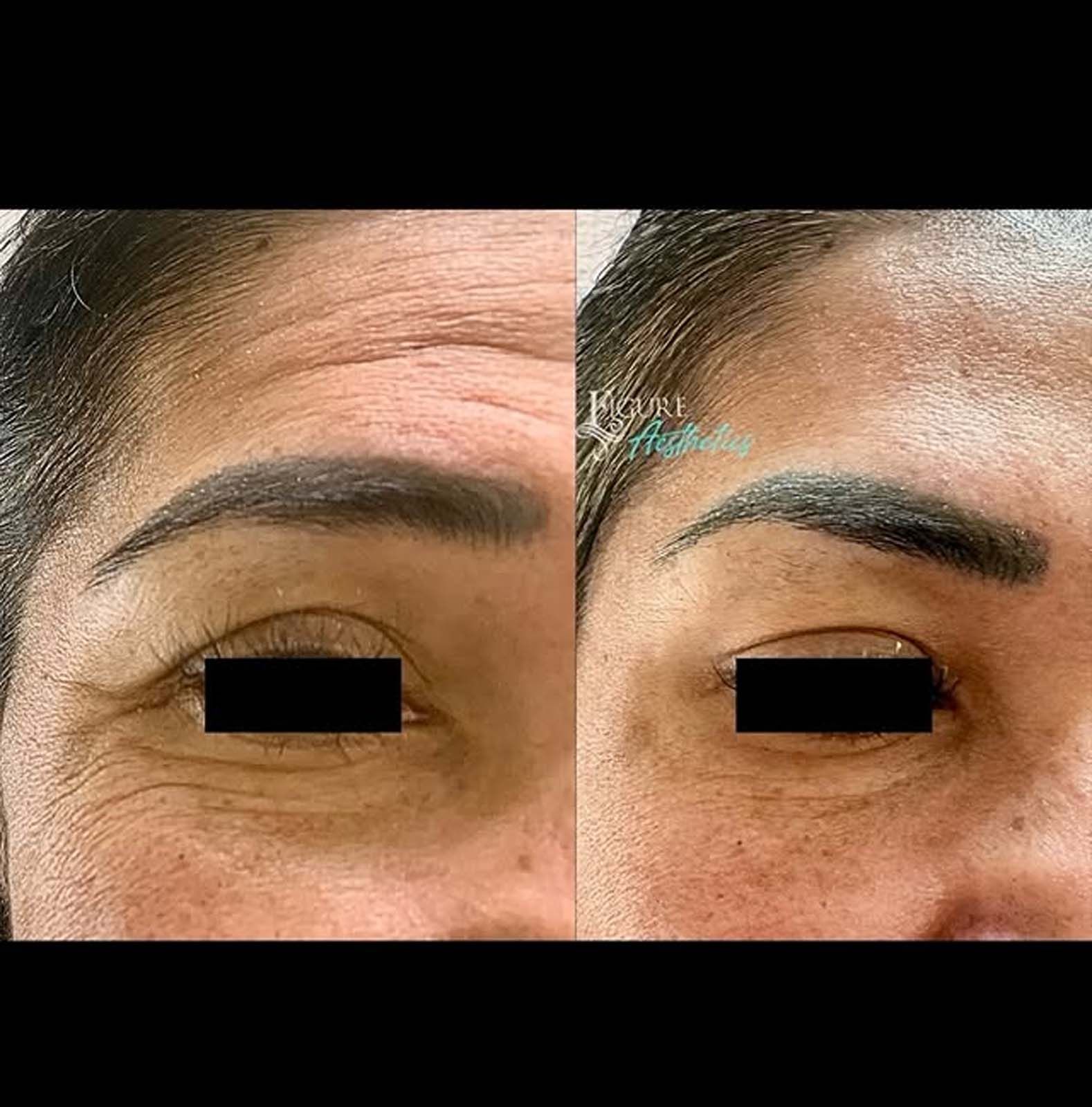 A before and after photo of a woman 's forehead and eyebrows.