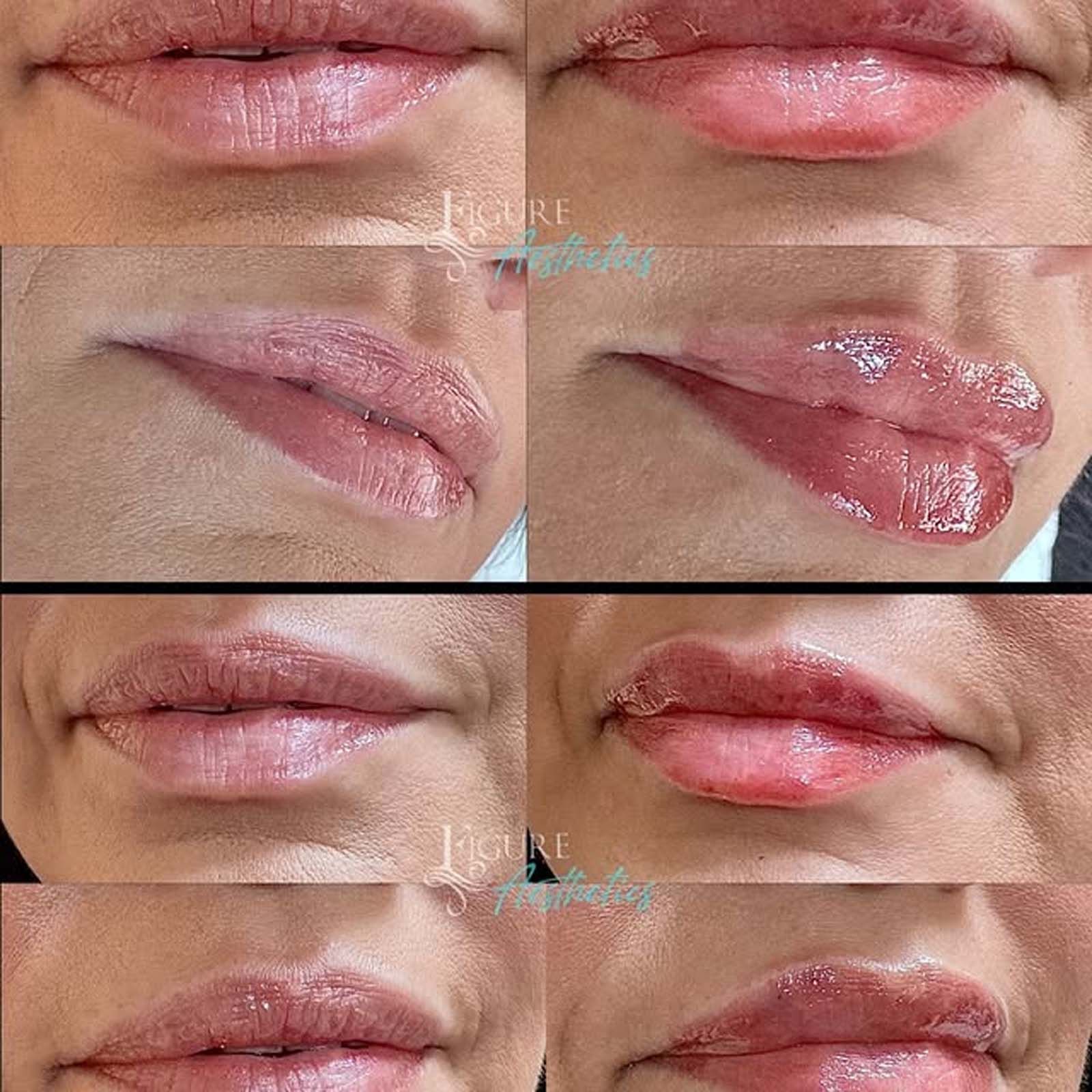 A collage of four pictures of a woman 's lips before and after lip injections.