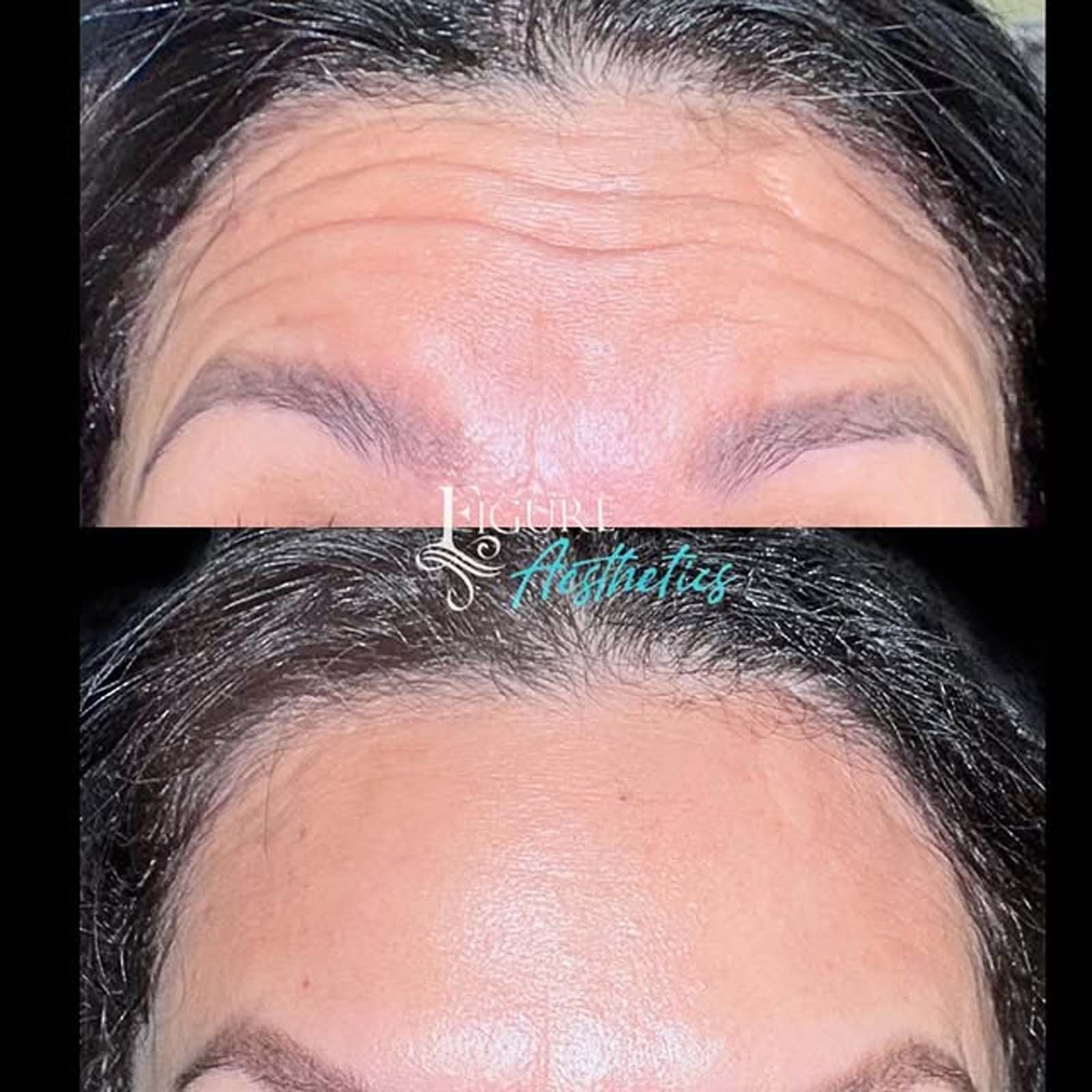 A before and after photo of a woman 's forehead with wrinkles.