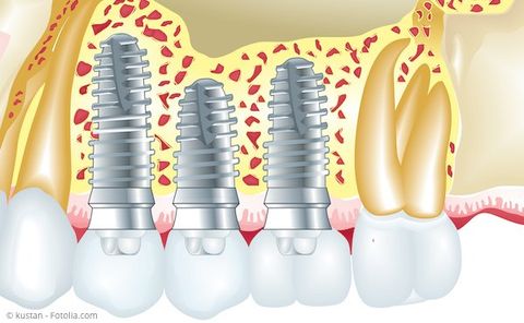 Implantate ersetzen fehlende Zähne und dienen der Befestigung von Zahnersatz
