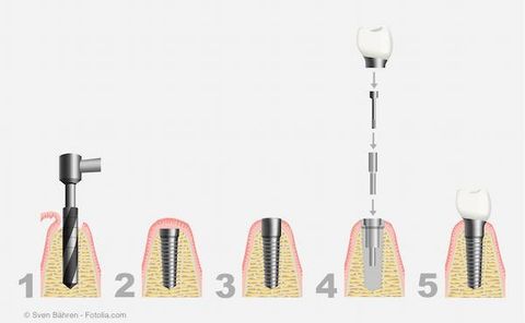 Die meisten Implantate werden im sog. zweiphasigen Verfahren eingesetzt.