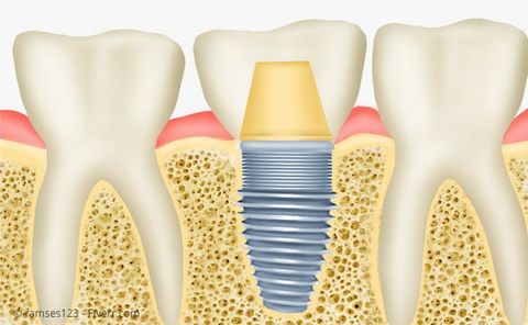 Beim Lückenschluss mit einem Implantat bleiben die Nachbarzähne verschont. Beim Lückenschluss mit einem Implantat bleiben die Nachbarzähne verschont.