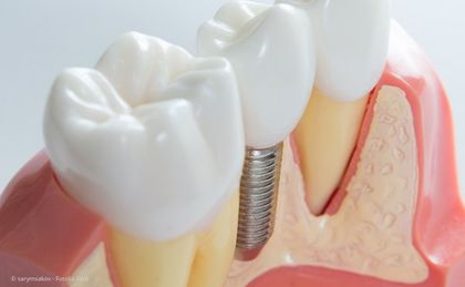 Mit der sogenannten Socket Preservation wird dem Abbau der Kiefer nach Zahnverlust vorgebeugt. Mit der sogenannten Socket Preservation wird dem Abbau der Kiefer nach Zahnverlust vorgebeugt.