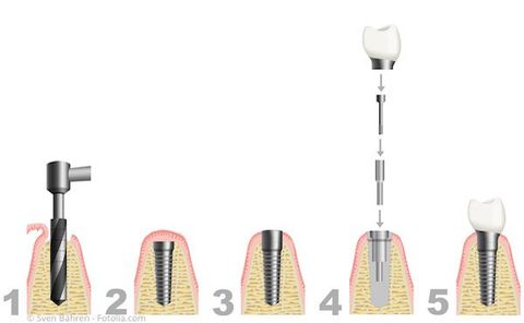 Ablauf einer Implantation