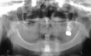 Operative Maßnahmen zur Verbesserung der Knochensituation vor Implantationen