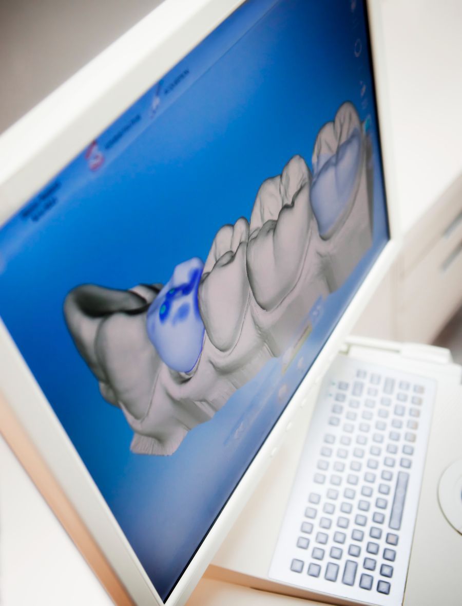 scansione dentale per la realizzazione di una protesi