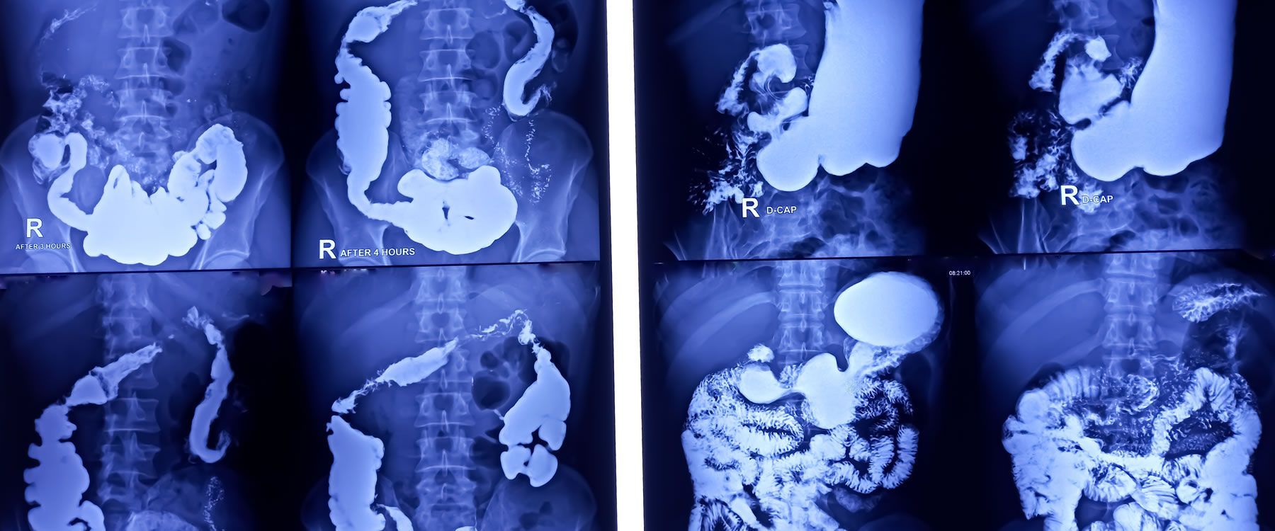 X-ray showing the gastrointestinal tract with contrast, highlighting the stomach and intestines.