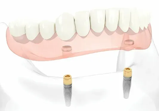 A Computer-Generated Image of a Denture with Two Dental Implants | Lismore, NSW | Active Denture Clinic