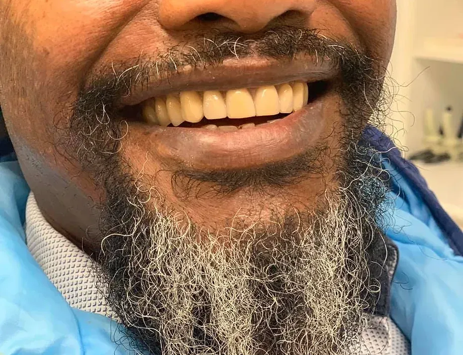 A Man with a Beard and White Teeth Is Smiling | Lismore, NSW | Active Denture Clinic