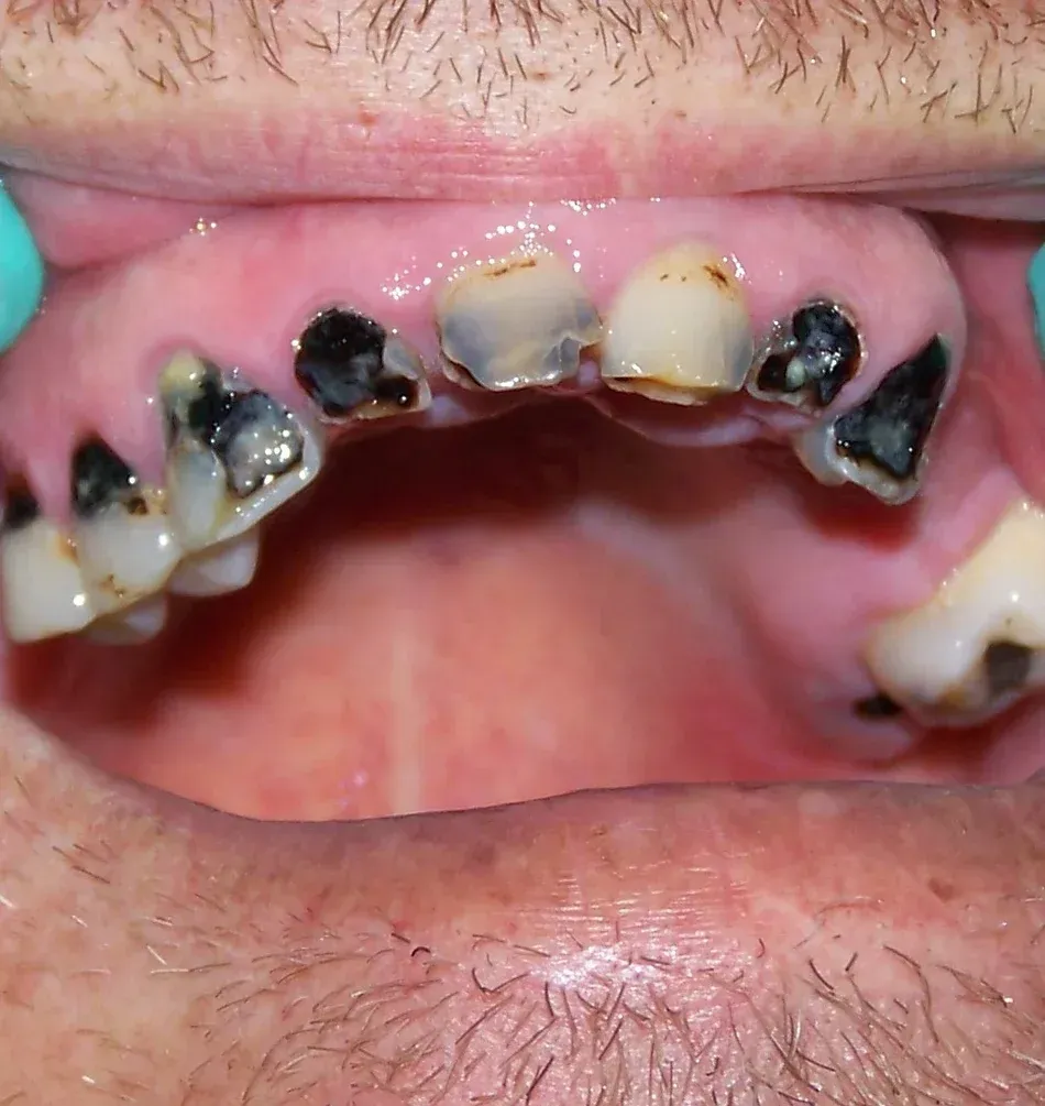 A Close-Up Image of a Person Teeth with Black Spots on Them | Lismore, NSW | Active Denture Clinic