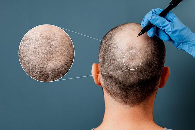 DR. LUIS GÓMEZ REZA - TRATAMIENTO DE ALOPECIA AREATA