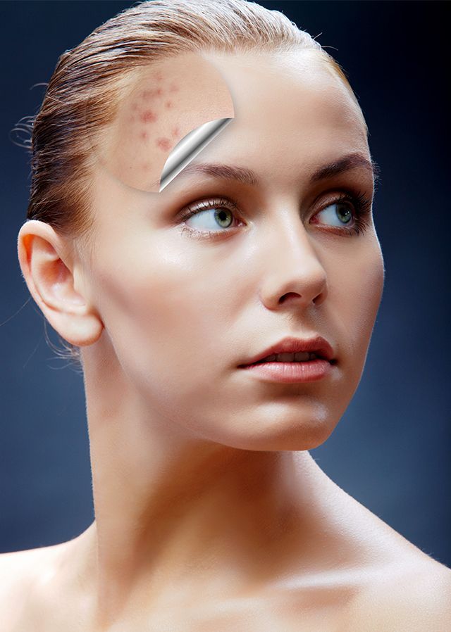 DR. LUIS GÓMEZ REZA - ACNÉ