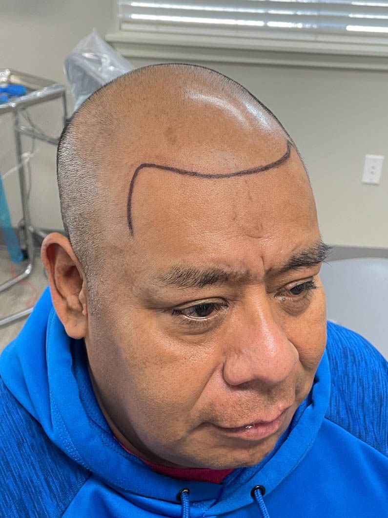 a man in a blue hoodie has a line drawn on his head