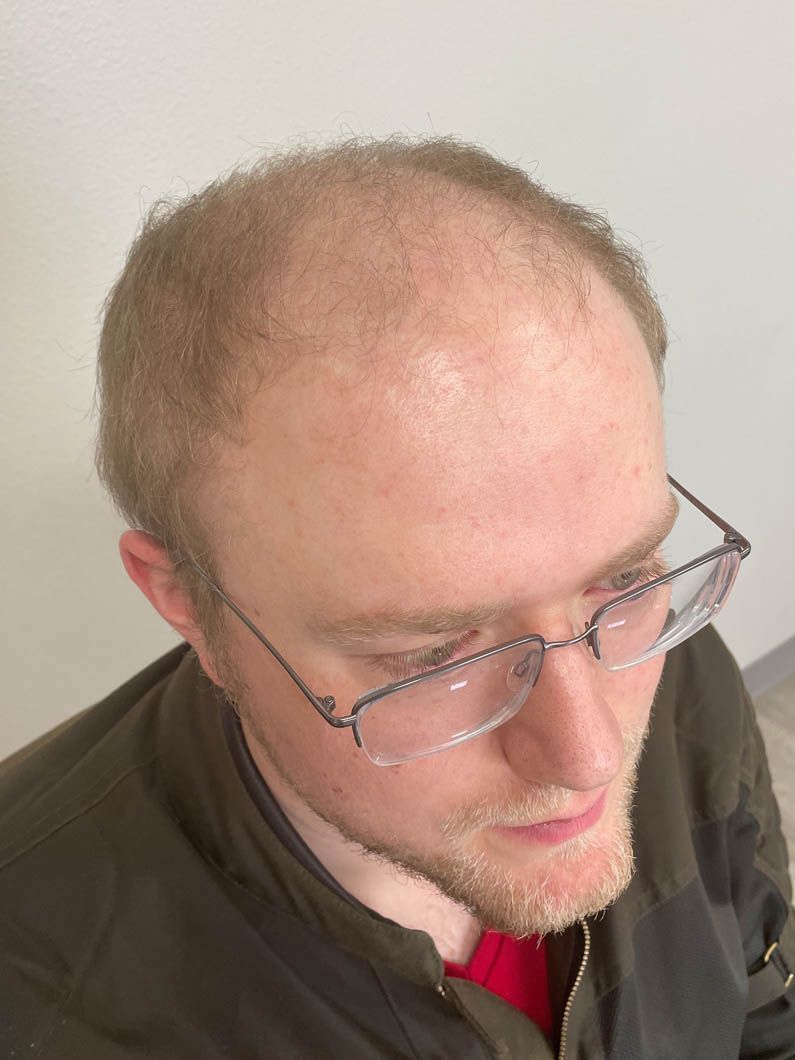 a bald man wearing glasses