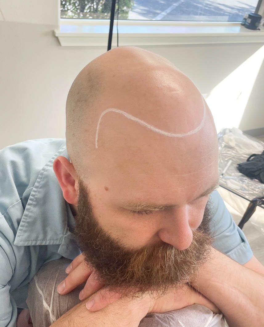 a man with a beard has a white line drawn on his head .