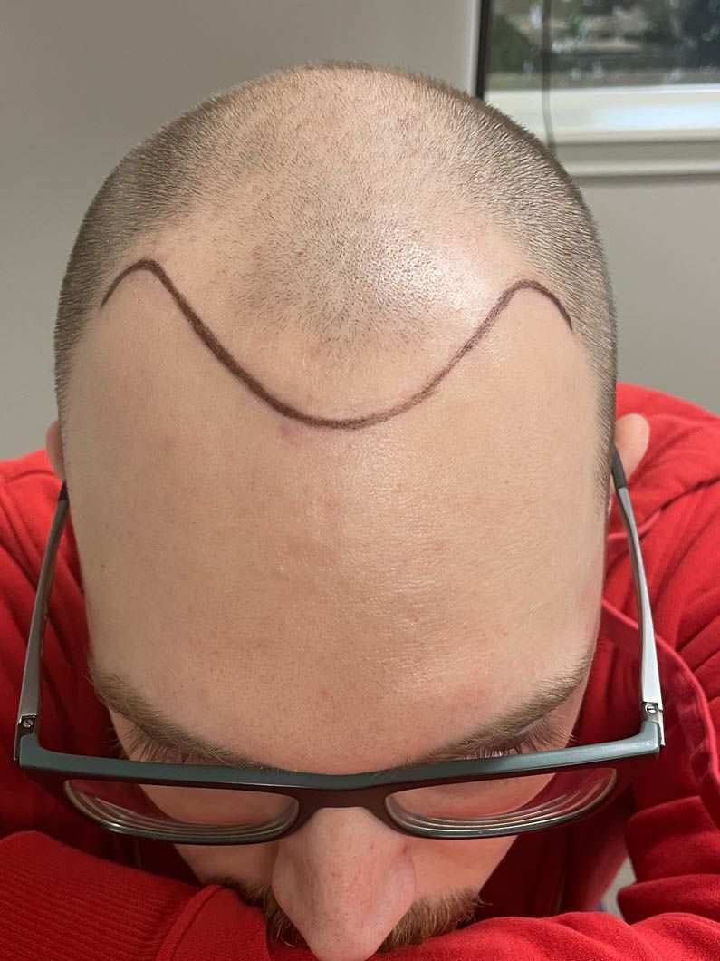 a man wearing glasses has a smiley face drawn on his forehead