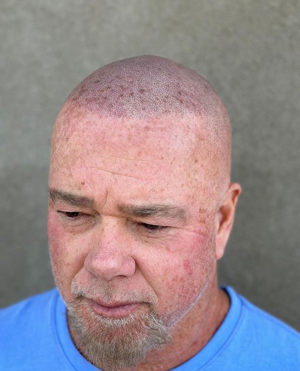 A person with a freshly shaved head, showing small incision dots from a recent hair transplant procedure.
