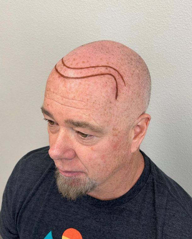 A person with a shaved head has a wavy, reddish-brown double-line tattoo drawn across their forehead and scalp.