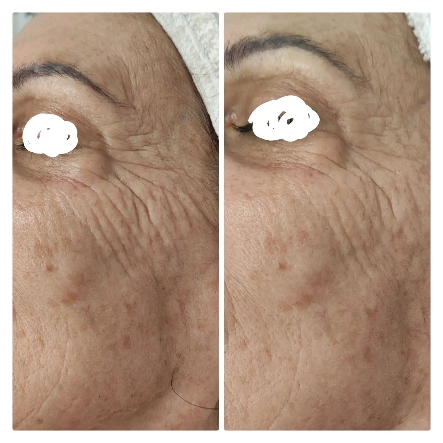 effetti di trattamento antietà per il contorno occhi