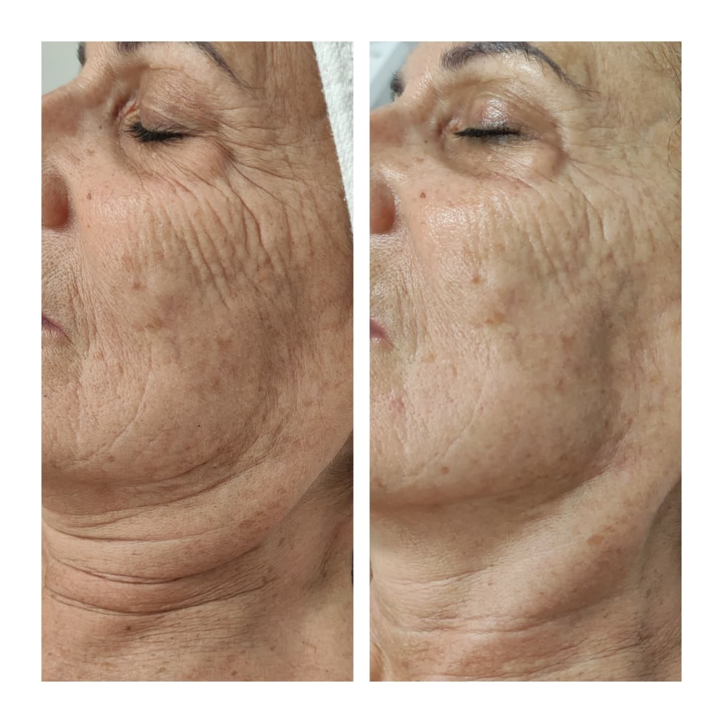 effetti di trattamento viso antietà