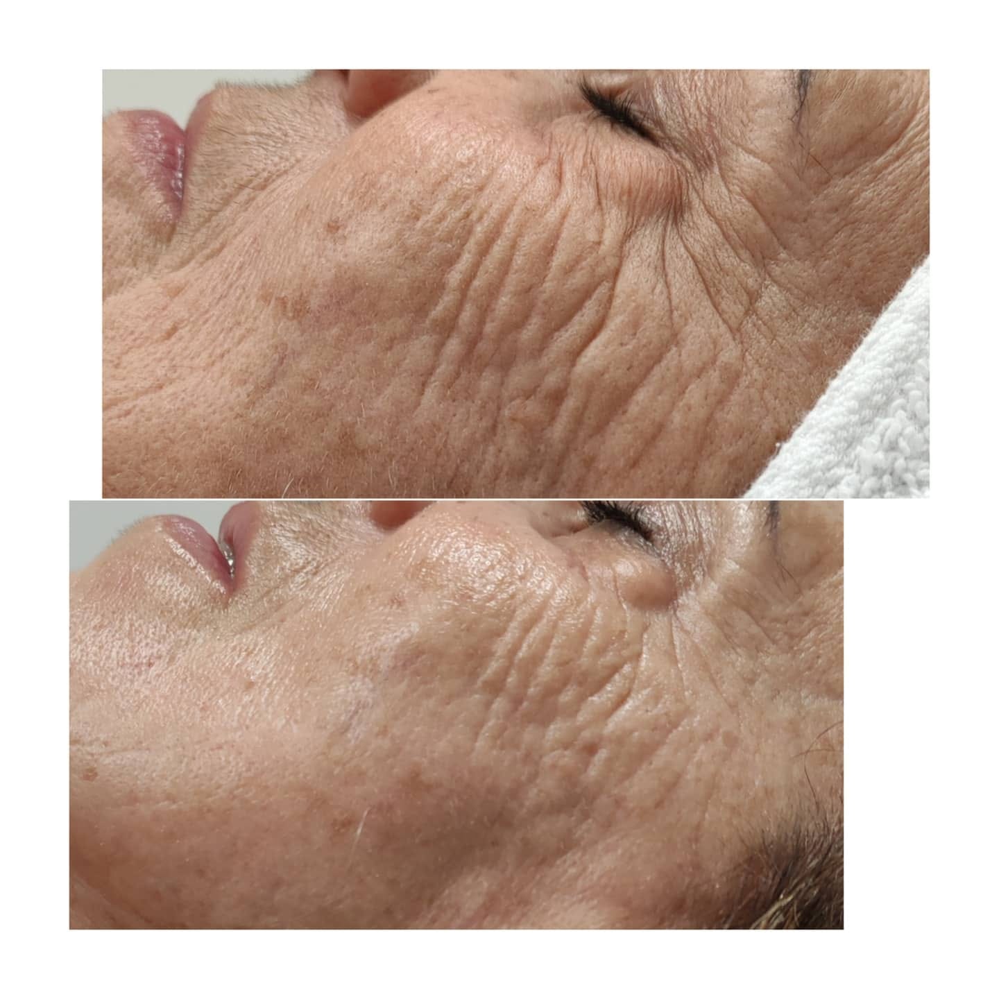 prima e dopo trattamento viso antietà