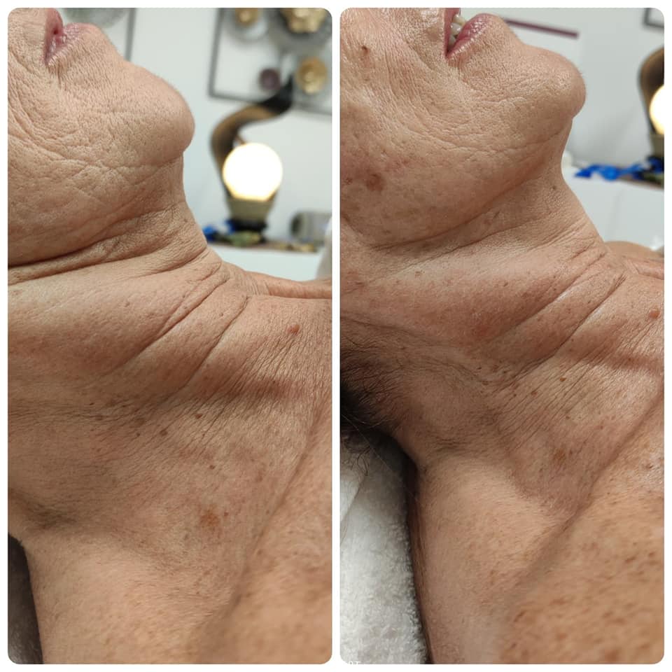 trattamento lifting per il collo