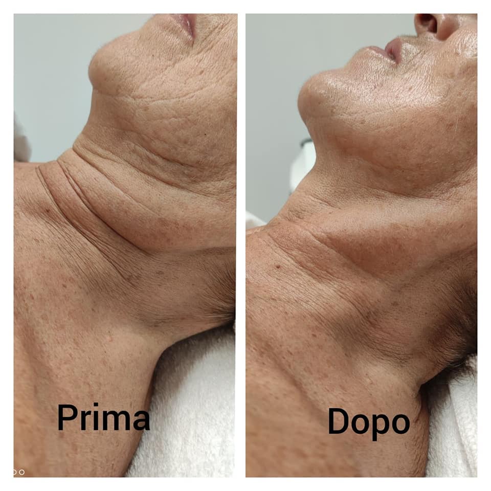 prima e dopo trattamento lifting per il collo