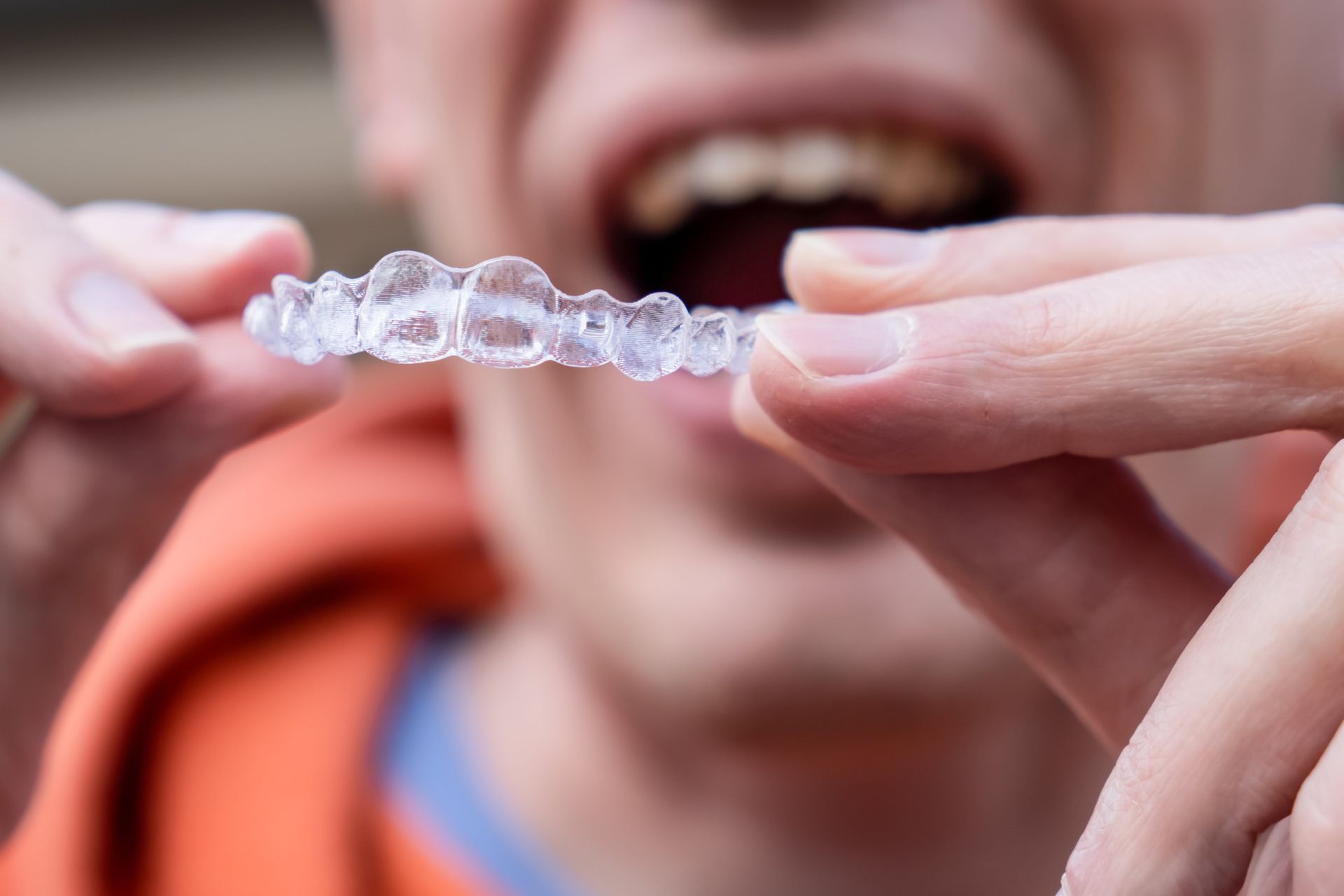 What Happens If You Wear Invisalign® Only at Night?