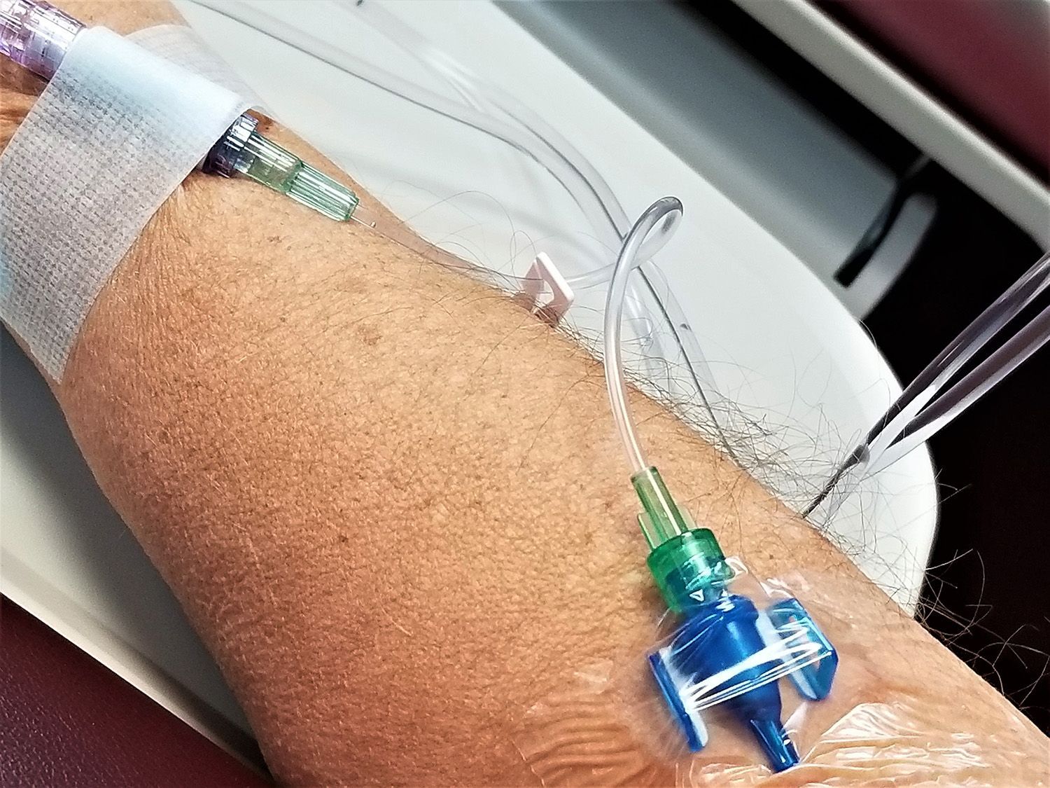 Arm with IV catheter and clear tubing secured by tape in a clinical setting