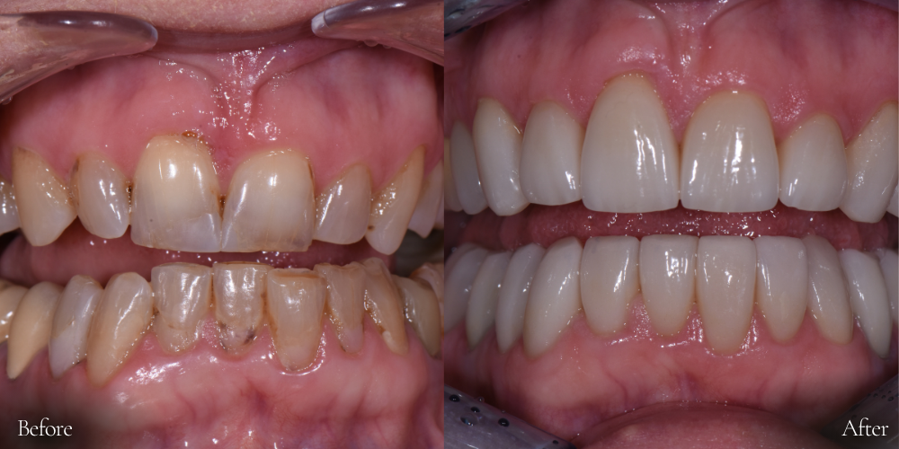 Before and after dental photo: stained teeth on the left, bright white teeth on the right.