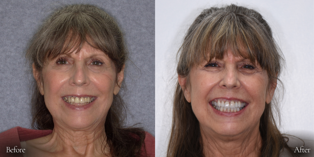 Side-by-side comparison of a person's smile before and after a dental procedure, with significant teeth improvement.