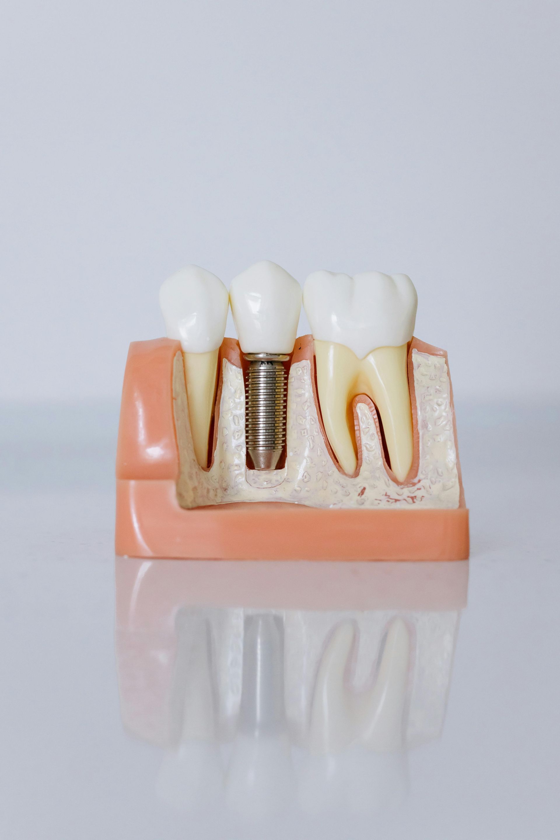 Model of teeth with dental implant, showing a cross-section of a jaw, with healthy and restored teeth.