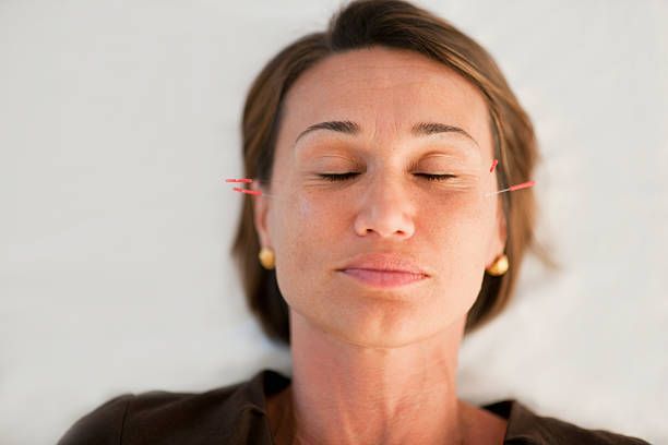 Top 10 benefits of Acupuncture