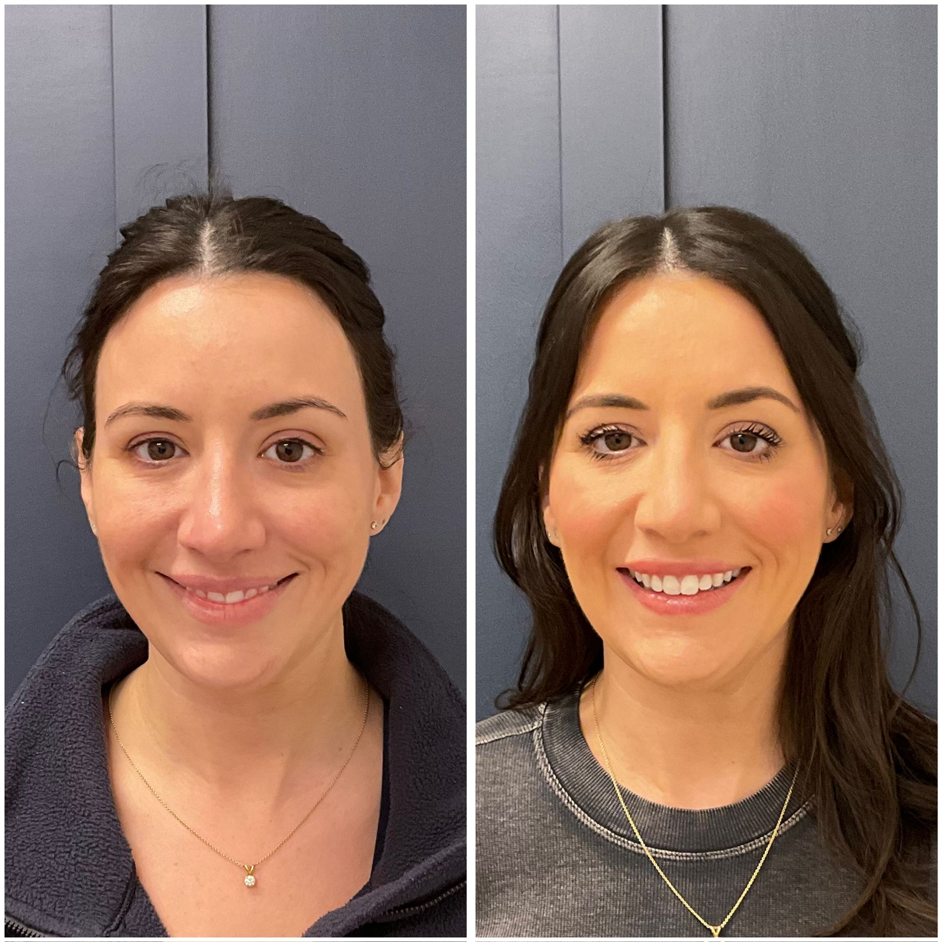 Compass Light patient after receiving injectable treatments in Cohasset.