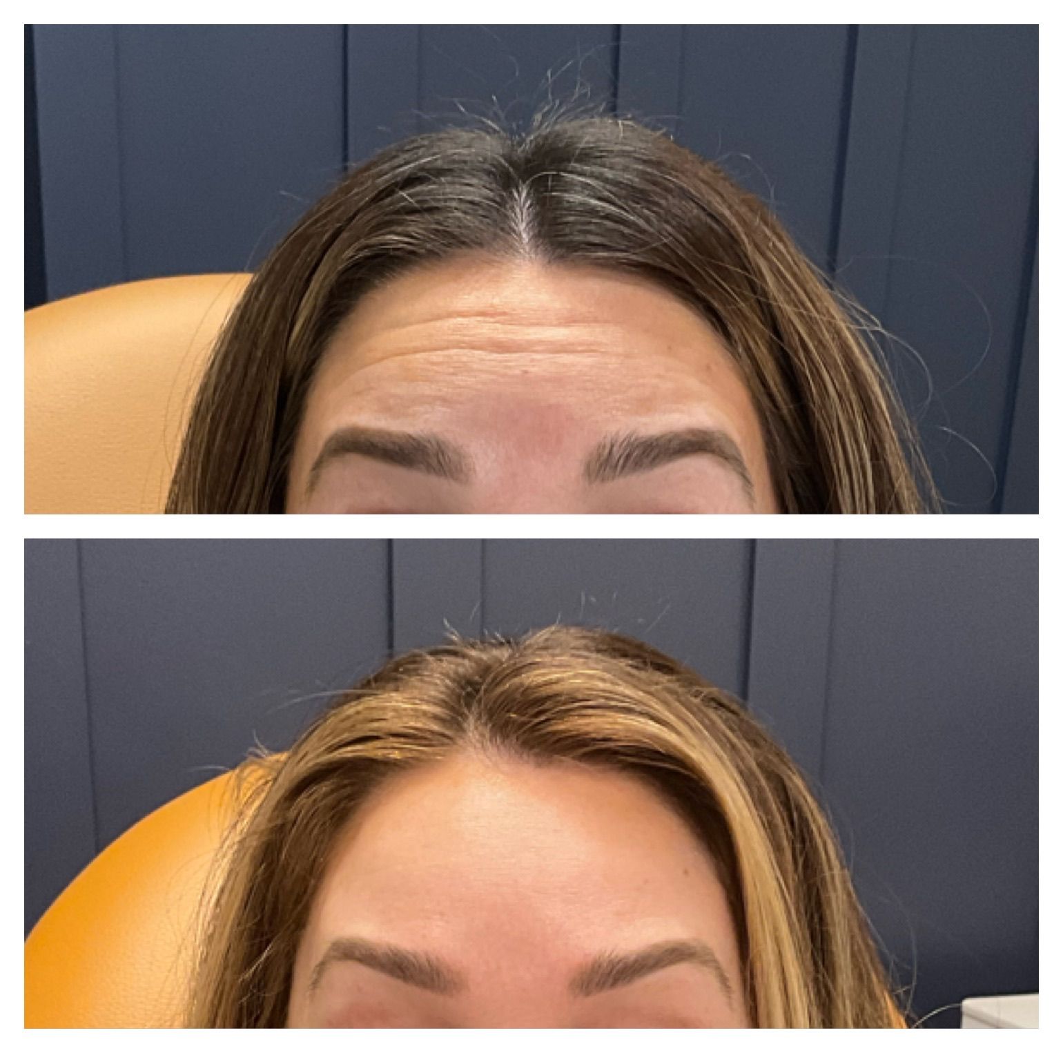 Compass Light patient before and after receiving filler and botox treatments in Cohasset.