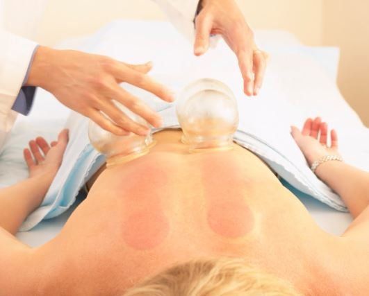Cupping — Philadelphia, PA — Advanced Physical Therapy