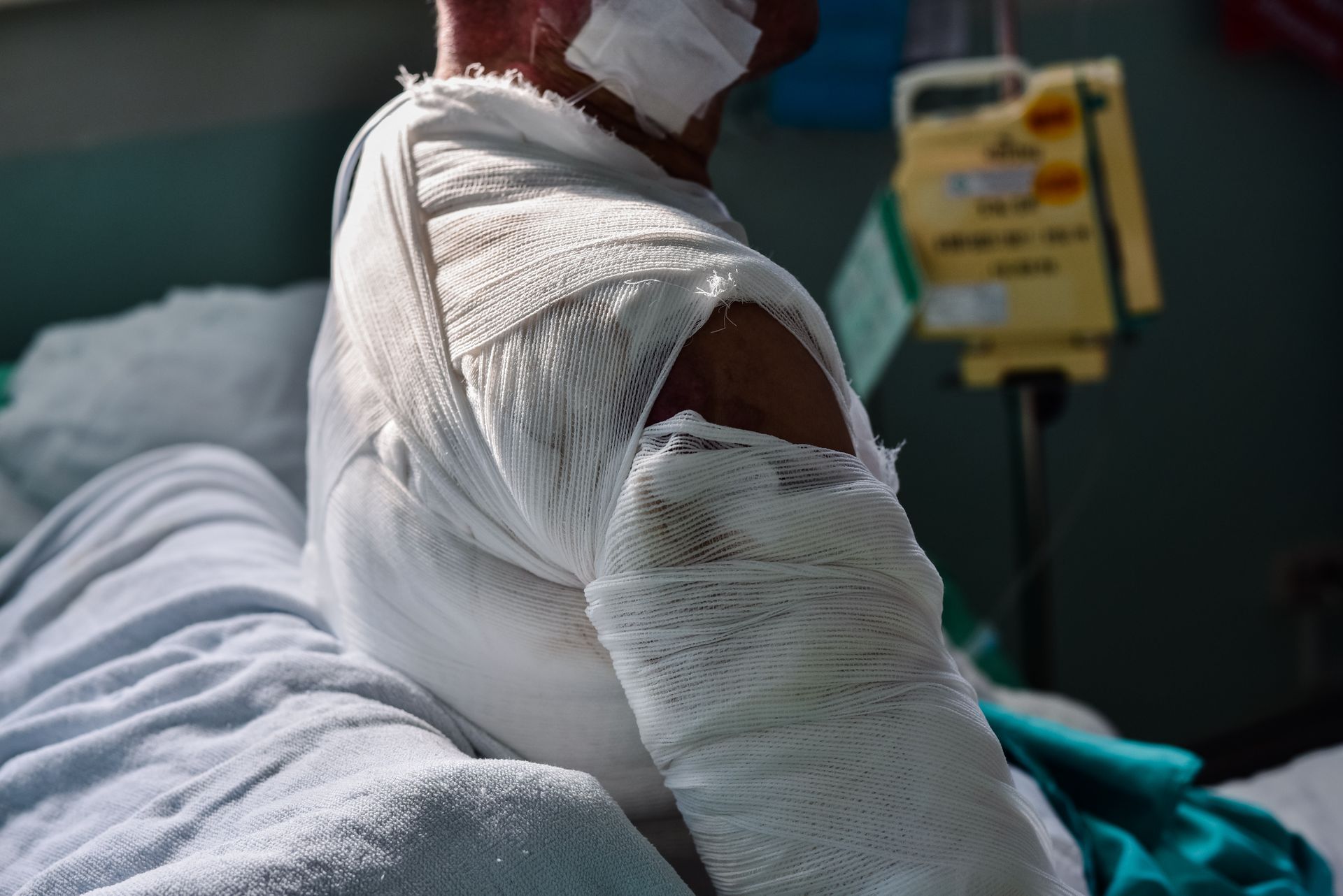 Burned patient in white bandages lying in a hospital bed with an IV line nearby