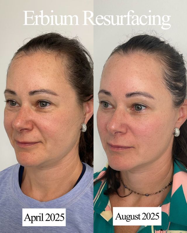 glp-1 treatment redondo beach ca Hyperpigmentation Help: Best Treatments in Redondo Beach for Uneven Skin  Tone
