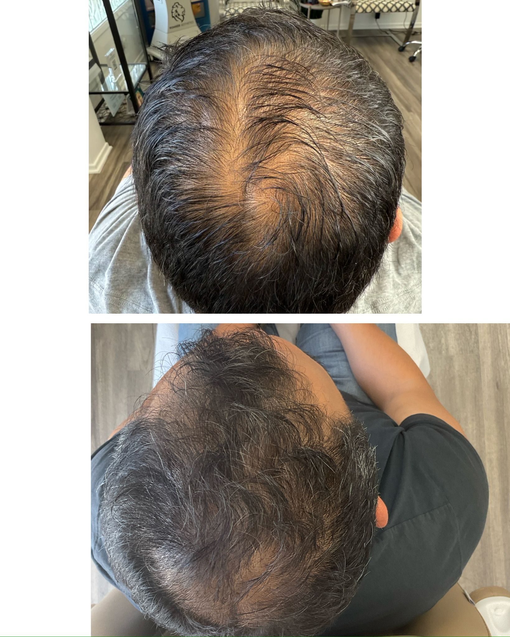 Before and after hair restoration from a male patient in Redondo Beach Ca. PRP for hair restoration. 