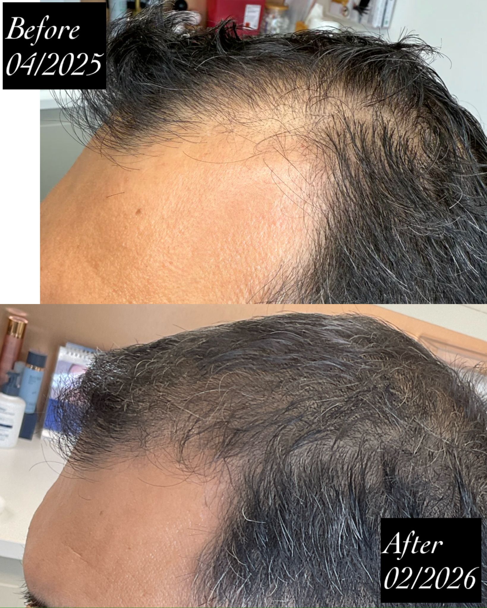 Before and after view of a person's of a man's scalp. His PRP Hair Restoration treatment in Redondo Beach, CA, has restored hair.