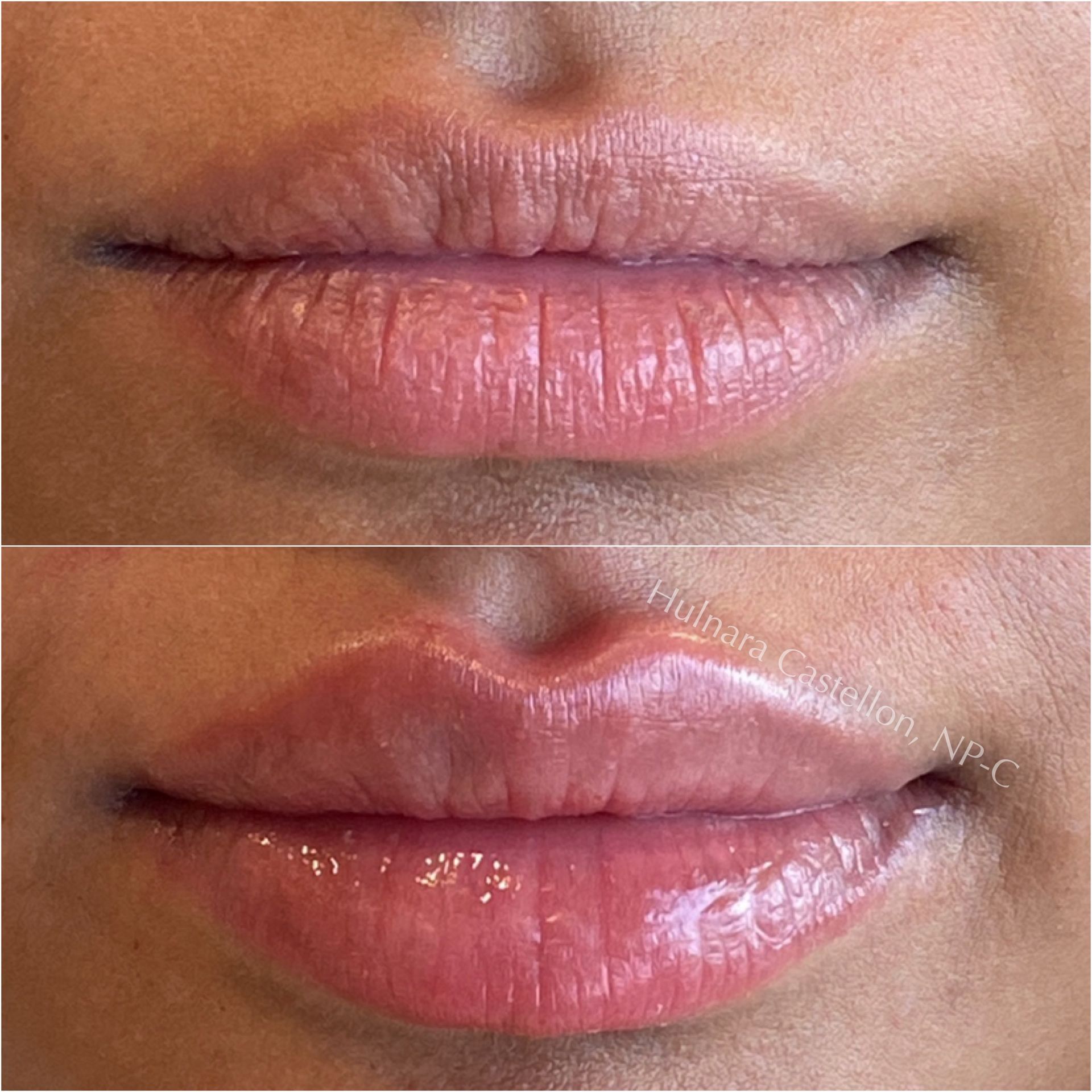 Before and after photos of a patient after lip filler in Redondo Beach, CA.