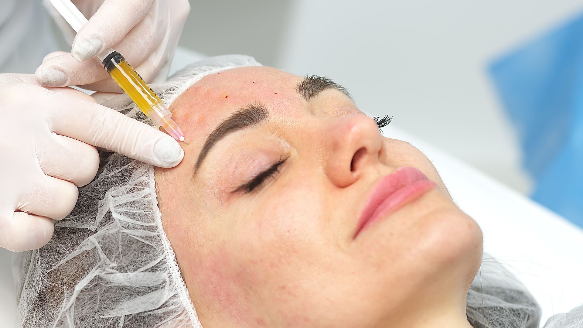 Eine Frau bekommt eine Botox-Injektion in die Stirn.