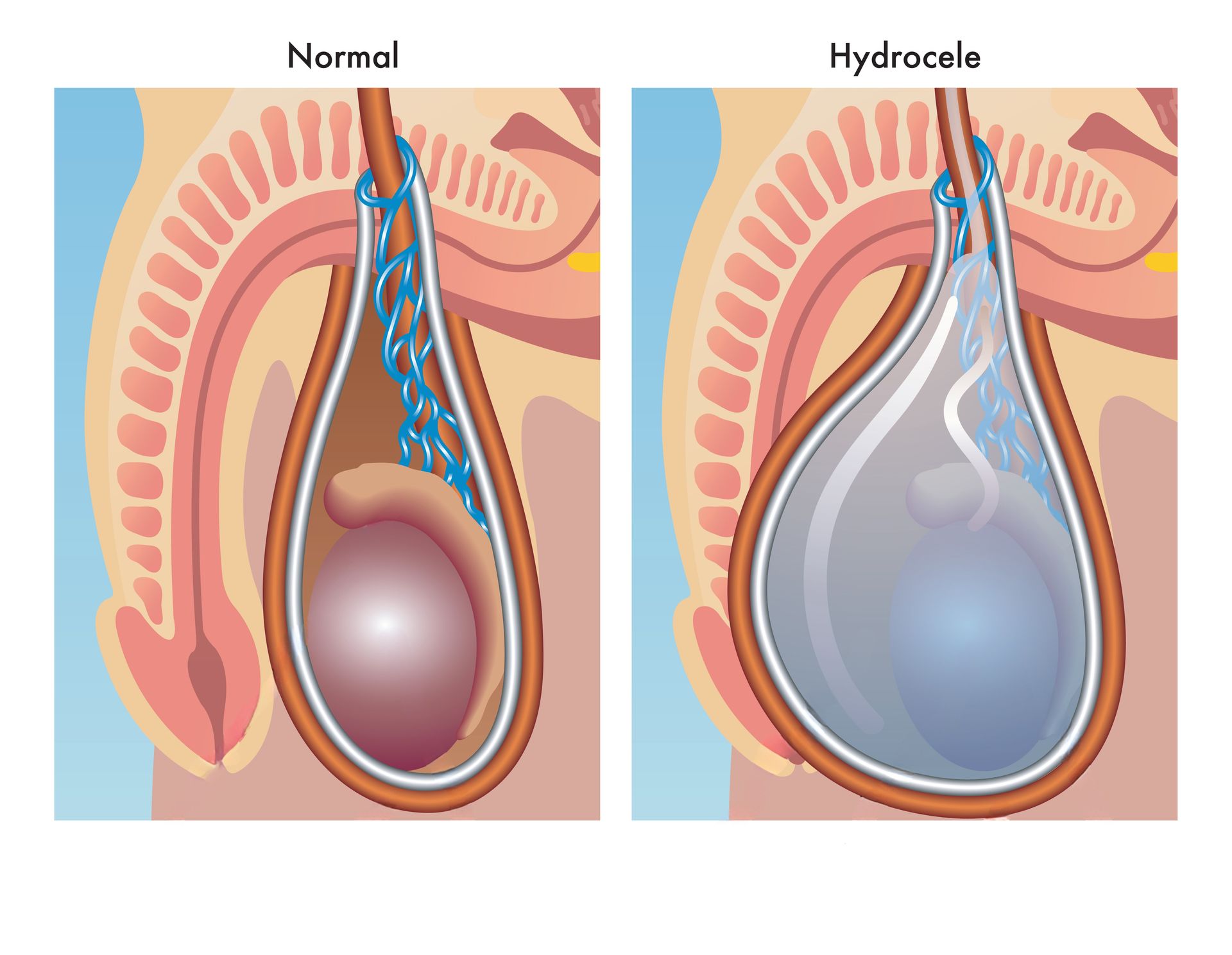hidrocele testicular