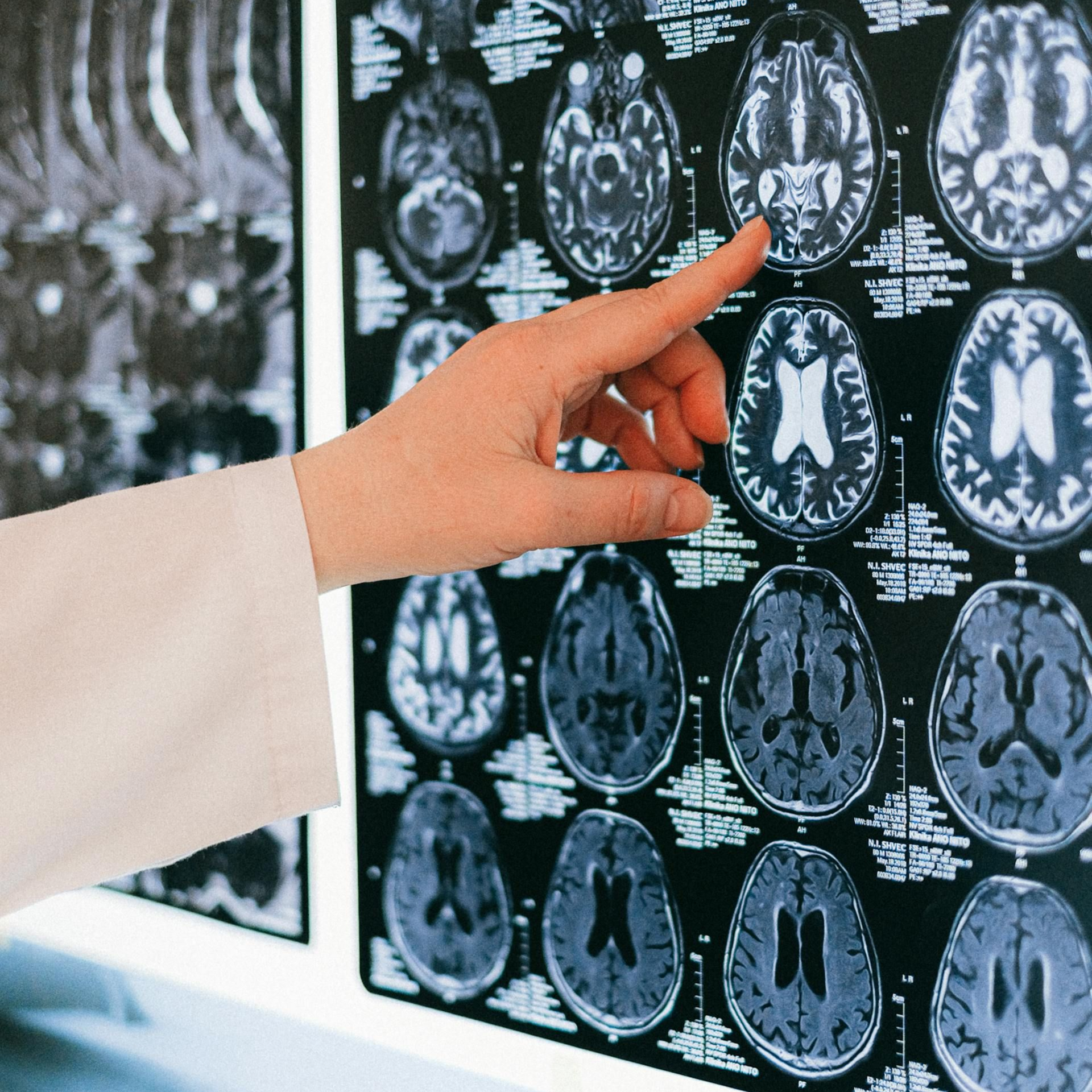 A person's hand points at brain scans on a screen.