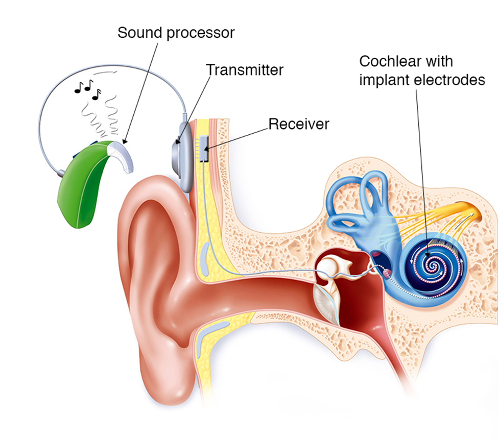 Diagram of a cochlear implant: Shows external components attached to the ear and the internal implant within the cochlea.