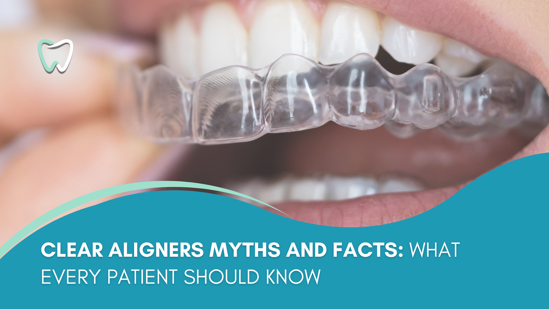 Close-up of a person's mouth with clear aligners being inserted; turquoise background with text.
